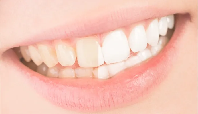 ホワイトニング